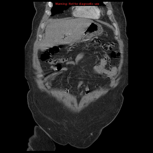 File:Abdominal aortic aneurysm (Radiopaedia 8190-9038 Coronal C+ arterial phase 25).jpg