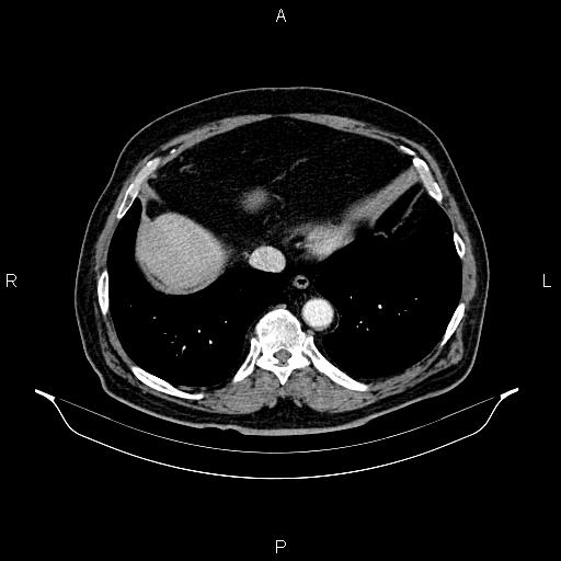 Abdominal aortic aneurysm (Radiopaedia 83094-97462 Axial renal cortical phase 60).jpg