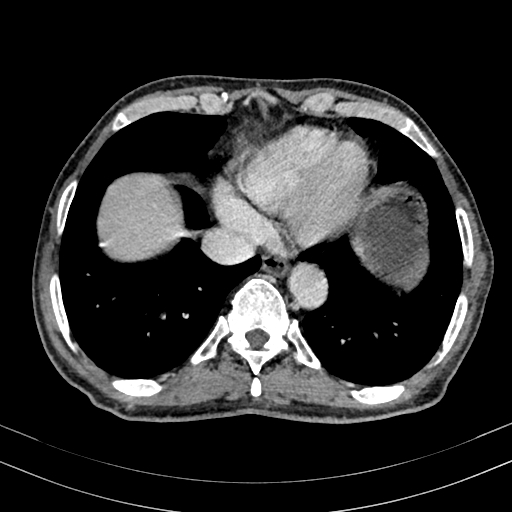Abdominal aortic aneurysm (Radiopaedia 83581-98689 Axial C+ portal venous phase 9).jpg