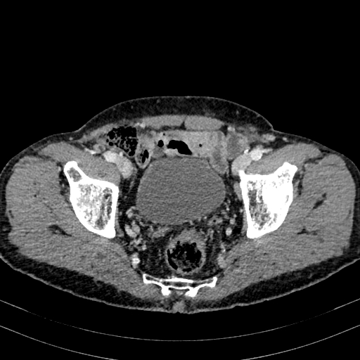 Abdominal aortic aneurysm (Radiopaedia 83581-98689 Axial C+ portal venous phase 99).jpg