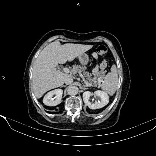 Abdominal aortic aneurysm (Radiopaedia 85063-100606 Axial C+ delayed 19).jpg