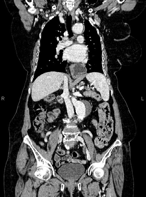 Abdominal aortic aneurysm (Radiopaedia 85063-100606 Coronal C+ arterial phase 29).jpg