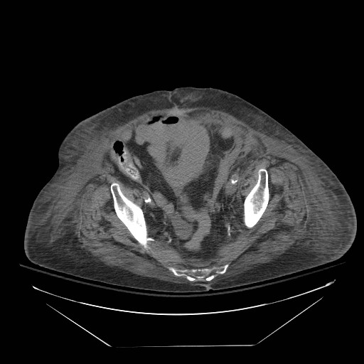 Abdominal aortic aneurysm - impending rupture (Radiopaedia 19233-19247 Axial non-contrast 138).jpg