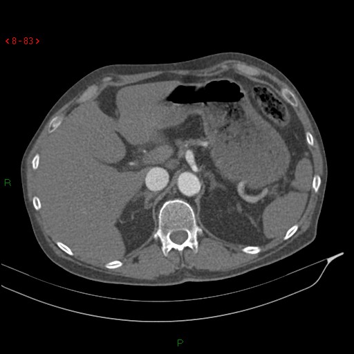 Abdominal aortic aneurysm rupture with aortocaval fistula (Radiopaedia 14897-14841 Axial C+ arterial phase 83).jpg