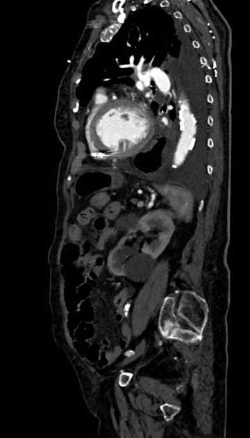Abdominal aortic aneurysm with thrombus fissuration (Radiopaedia 73192-83919 Sagittal C+ arterial phase 41).jpg