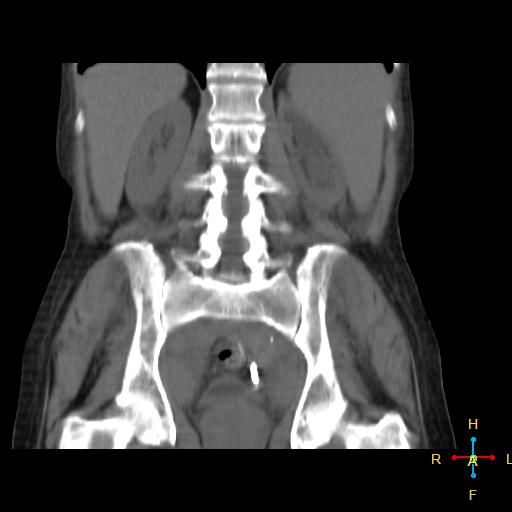 File:Abdominal lymphoma (Radiopaedia 23085-23115 Coronal non-contrast 5).jpg