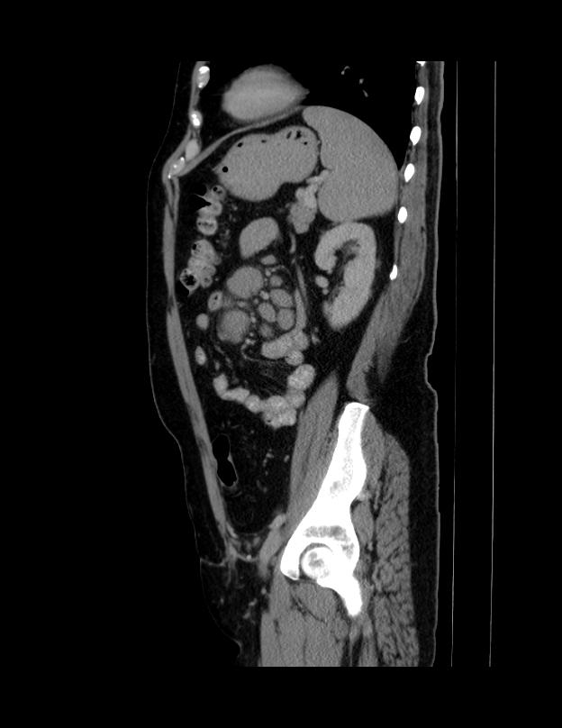Abdominal lymphoma - with sandwich sign (Radiopaedia 53486-59492 Sagittal C+ portal venous phase 22).jpg