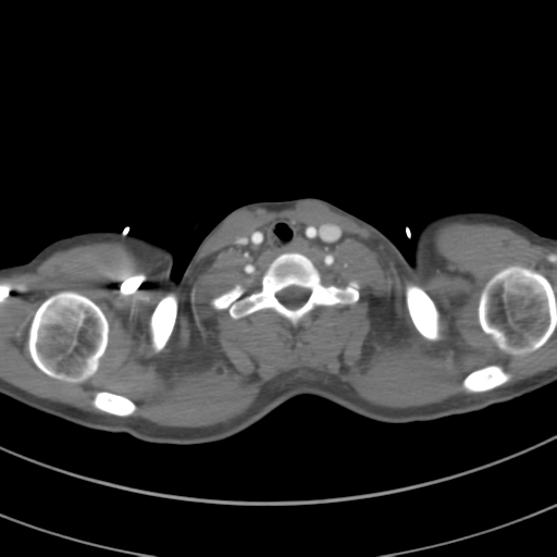 Abdominal multi-trauma - devascularised kidney and liver, spleen and pancreatic lacerations (Radiopaedia 34984-36486 Axial C+ arterial phase 5).png