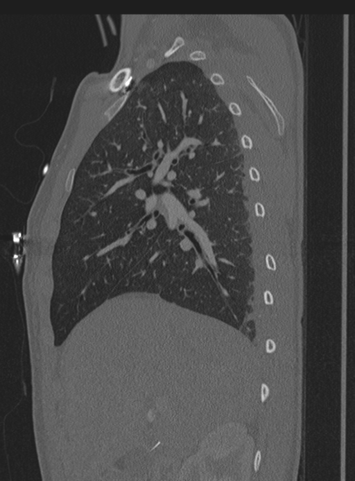 Abdominal multi-trauma - devascularised kidney and liver, spleen and pancreatic lacerations (Radiopaedia 34984-36486 Sagittal bone window 65).png