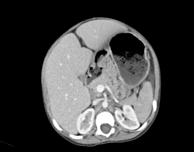 Abdominal premesenteric cystic lymphangioma (Radiopaedia 82995-97350 Axial C+ portal venous phase 19).jpg