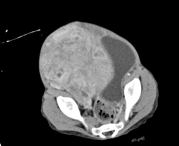 Abdominopelvic rhabdomyosarcoma (Radiopaedia 78356-90984 Axial C+ portal venous phase 136).jpg