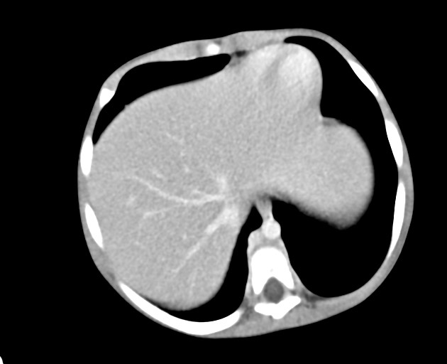 Abdominopelvic rhabdomyosarcoma (Radiopaedia 78356-90984 Axial C+ portal venous phase 39).jpg