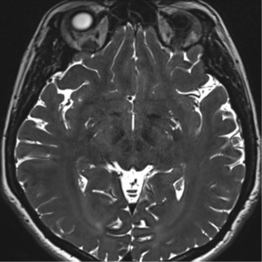 Abducens nerve palsy (Radiopaedia 51069-56648 Axial T2 fat sat 82).png