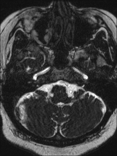 Abducens nerve palsy (Radiopaedia 57084-63976 Axial T2 ciss 3d 16).jpg