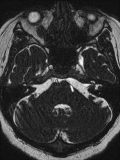 Abducens nerve palsy (Radiopaedia 57084-63976 Axial T2 ciss 3d 26).jpg