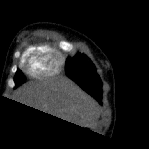 File:Aberrant left pulmonary artery (pulmonary sling) (Radiopaedia 42323-45435 Coronal C+ CTPA 24).jpg