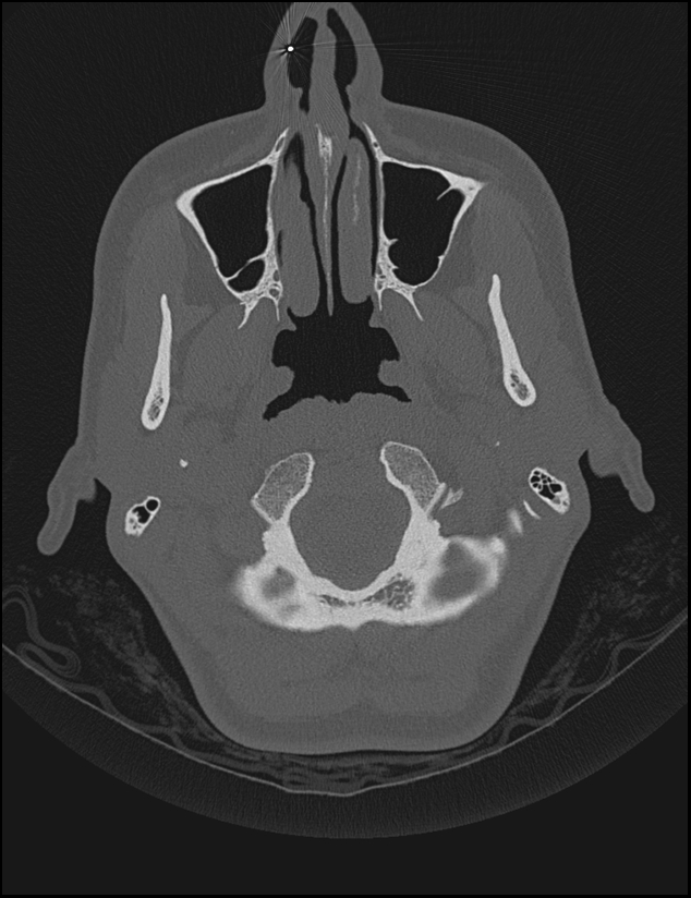 Aberrant right internal carotid artery (Radiopaedia 65191-74198 Axial non-contrast 8).jpg