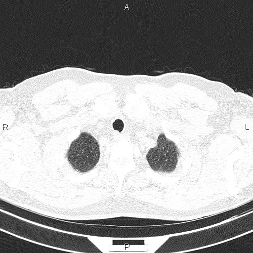 Aberrant right subclavian artery (Radiopaedia 87093-103354 Axial lung window 13).jpg