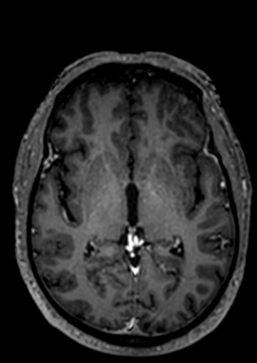 Accessory middle cerebral artery (Radiopaedia 73114-83828 Axial T1 C+ 37).jpg