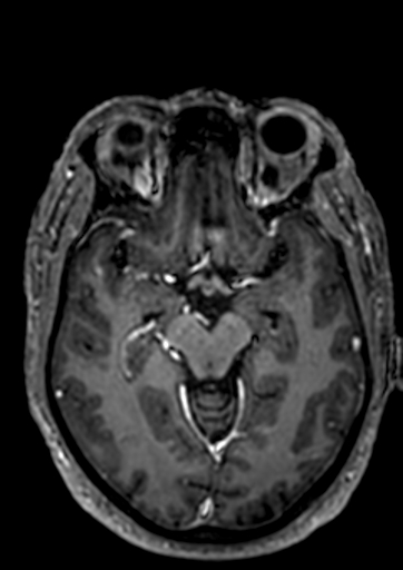 File:Accessory middle cerebral artery (Radiopaedia 73114-83828 Axial T1 C+ 68).jpg