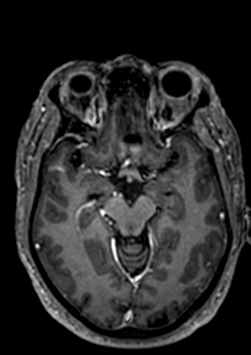 Accessory middle cerebral artery (Radiopaedia 73114-83828 Axial T1 C+ 70).jpg