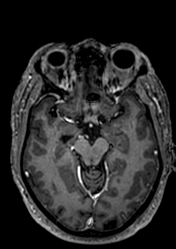 Accessory middle cerebral artery (Radiopaedia 73114-83828 Axial T1 C+ 72).jpg