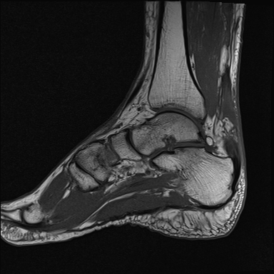 File:Achilles tendon tear (Radiopaedia 77615-89819 Sagittal T1 10).jpg