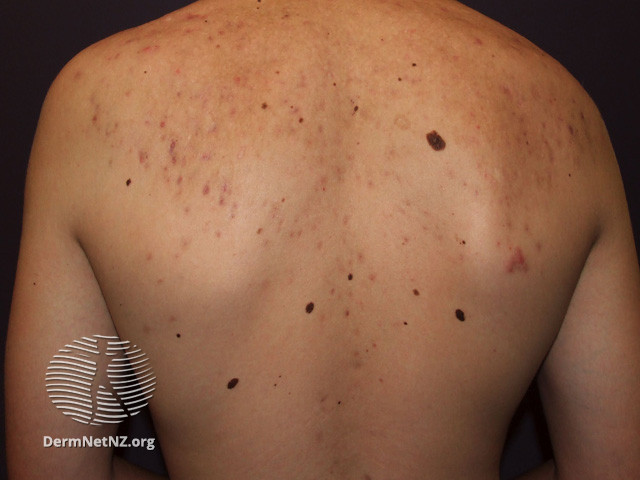 File:Acne affecting the back images (DermNet NZ acne-acne-back-160).jpg
