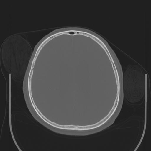 File:Acoustic schwannoma (Radiopaedia 29488-29982 AXIAL BONE THICK non-contrast 33).jpg