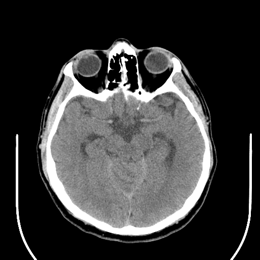 File:Acoustic schwannoma (Radiopaedia 39170-41388 Axial non-contrast 20).png