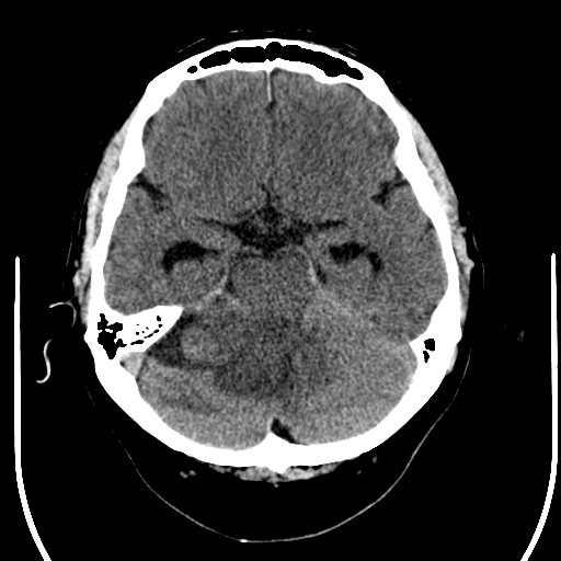 File:Acoustic schwannoma (Radiopaedia 39170-41389 Axial non-contrast 9).png