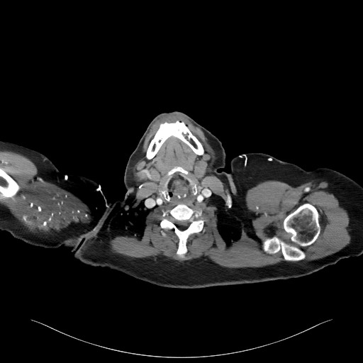 Acromioclavicular joint cyst (Radiopaedia 58455-65610 Axial C+ arterial phase 7).jpg