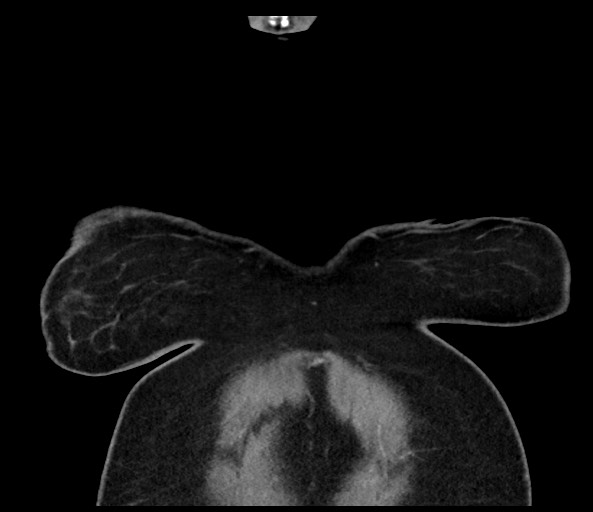 Acromioclavicular joint cyst (Radiopaedia 58455-65610 Coronal C+ arterial phase 17).jpg