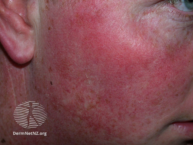 Actinic Keratoses affecting the face (DermNet NZ lesions-ak-face-435).jpg