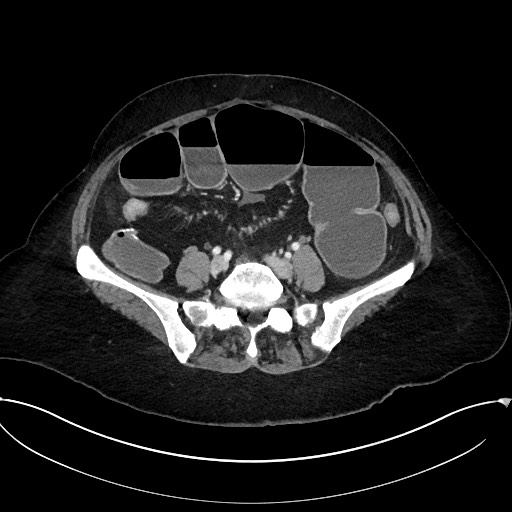 Active Crohn disease (Radiopaedia 59394-66750 Axial C+ portal venous phase 49).jpg