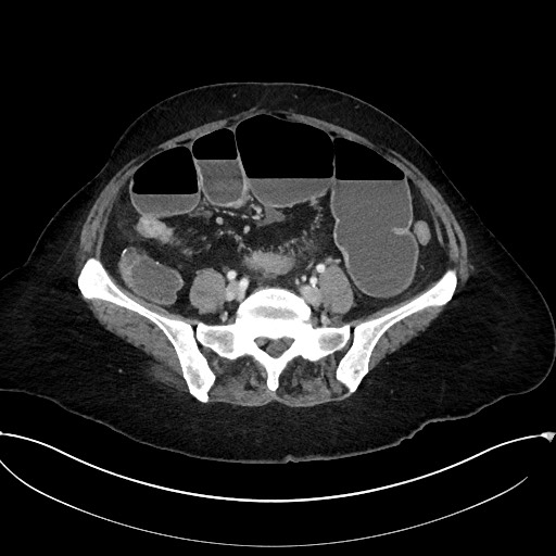 Active Crohn disease (Radiopaedia 59394-66750 Axial C+ portal venous phase 50).jpg