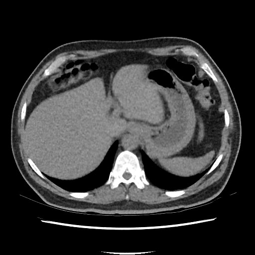 Active colonic bleed on CT (Radiopaedia 49765-55025 Axial non-contrast 13).jpg
