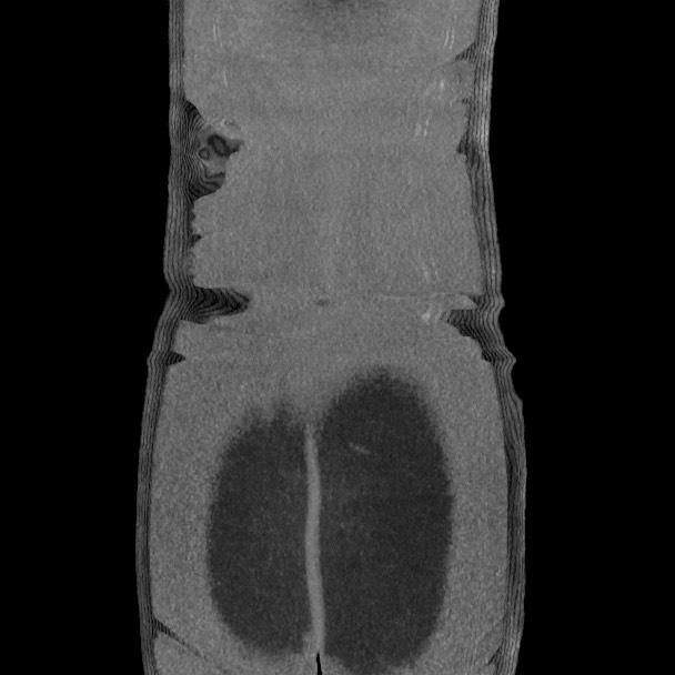 Active colonic bleed on CT (Radiopaedia 49765-55025 Coronal art MIP 61).jpg