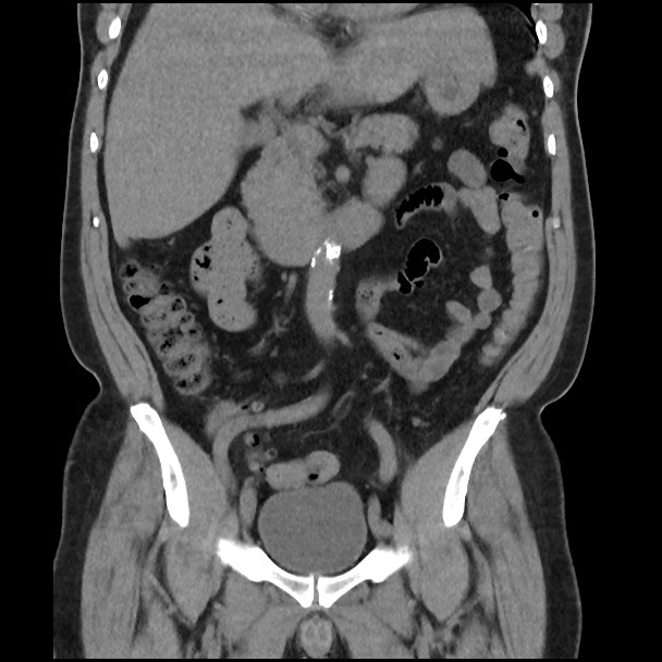 Active colonic bleed on CT (Radiopaedia 49765-55025 Coronal non-contrast 26).jpg