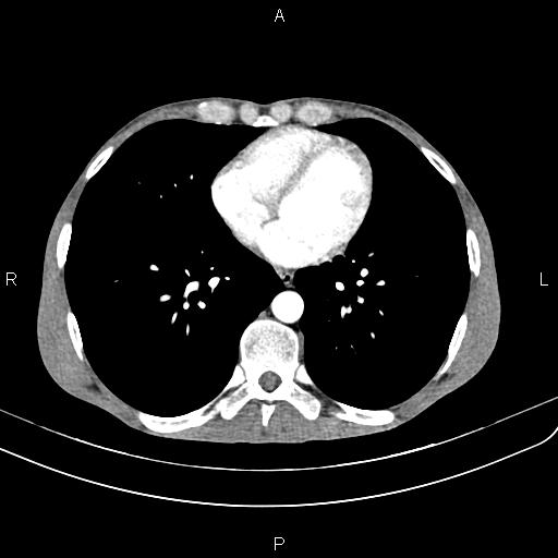 Active crohn disease (Radiopaedia 87133-103397 Axial C+ arterial phase 1).jpg