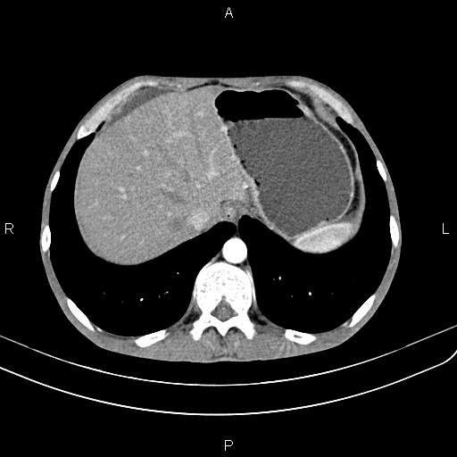 Active crohn disease (Radiopaedia 87133-103397 Axial C+ arterial phase 17).jpg