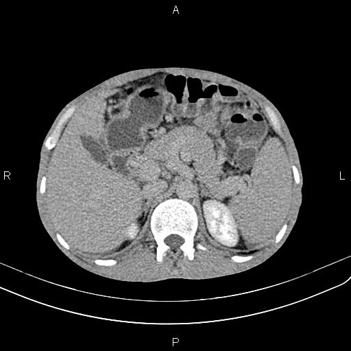 Active crohn disease (Radiopaedia 87133-103397 Axial C+ delayed 7).jpg