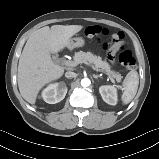 File:Active diverticular hemorrhage (Radiopaedia 39415-41725 Axial C+ arterial phase 19).png
