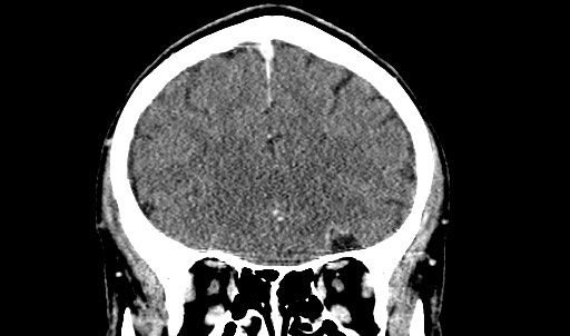 File:Active neurocysticercosis before and after therapy (Radiopaedia 71710-82099 Coronal C+ delayed 25).jpg