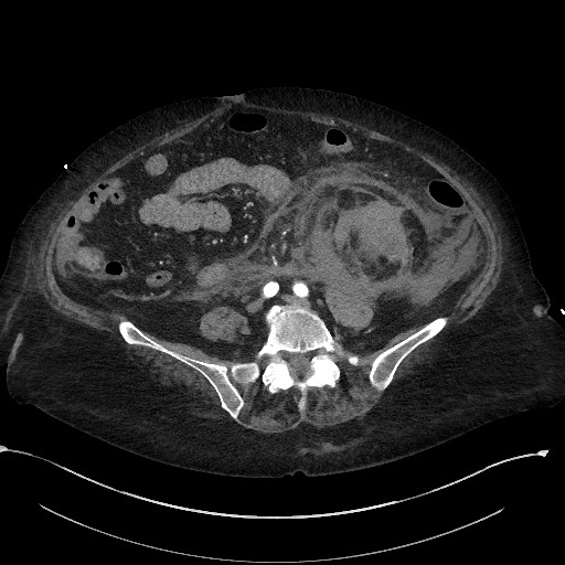 File:Active renal extravasation with large subcapsular and retroperitoneal hemorrhage (Radiopaedia 60975-68796 Axial 24).jpg