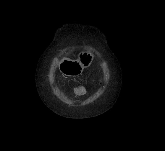 Active renal extravasation with large subcapsular and retroperitoneal hemorrhage (Radiopaedia 60975-68796 Coronal C+ arterial phase 19).jpg
