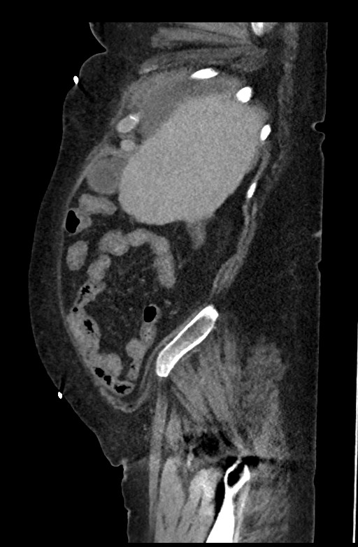 Active renal extravasation with large subcapsular and retroperitoneal hemorrhage (Radiopaedia 60975-68796 Sagittal C+ portal venous phase 179).jpg