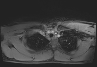 File:Active right ventricular cardiac sarcoidosis (Radiopaedia 55596-62100 Axial Post contrast Dixon 4).jpg