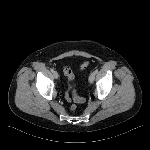 Acute-on-chronic pancreatitis (Radiopaedia 67286-76656 Axial C+ portal venous phase 72).jpg