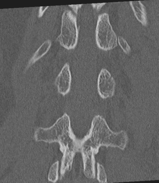 Acute L1 burst compression fracture (Radiopaedia 34430-35755 Coronal bone window 42).png